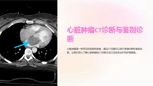 心脏肿瘤CT诊断与鉴别诊断