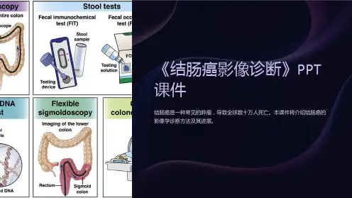 《结肠癌影像诊断》课件