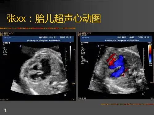 完全性肺静脉异位连接PPT课件