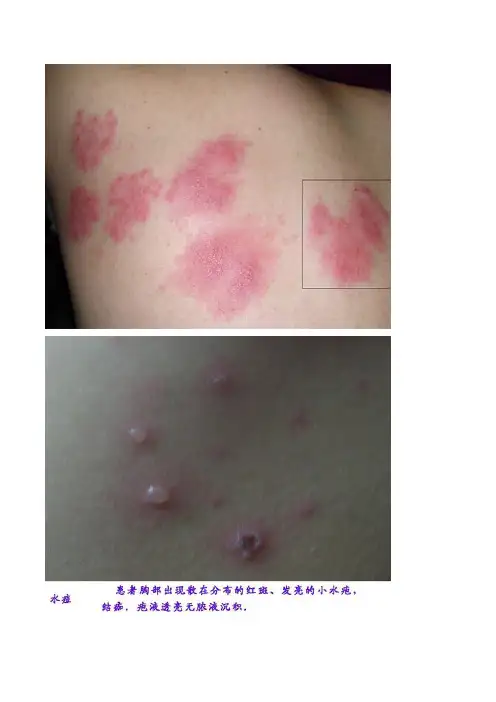 婴儿水痘症状图片及治疗