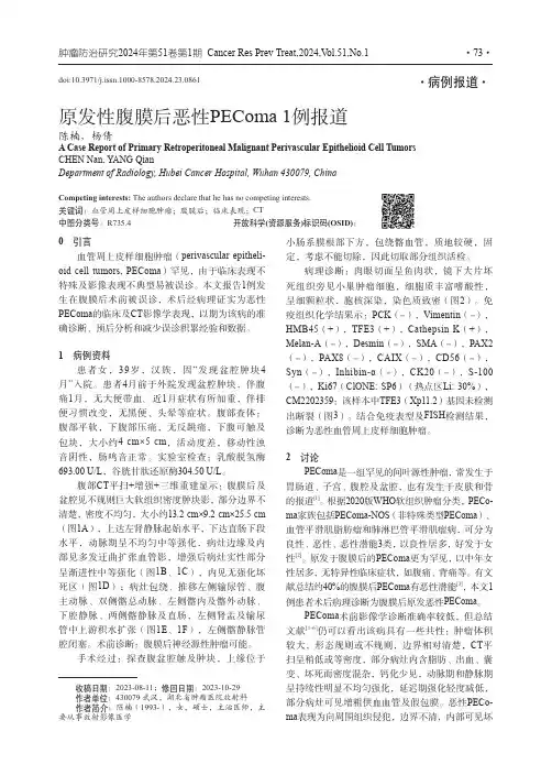 原发性腹膜后恶性PEComa_1例报道