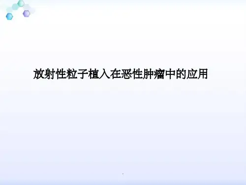 放射性粒子植入技术ppt精选课件