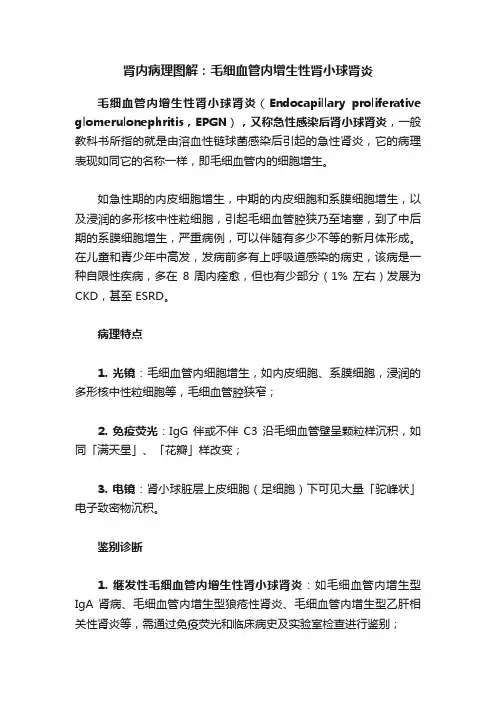 肾内病理图解：毛细血管内增生性肾小球肾炎