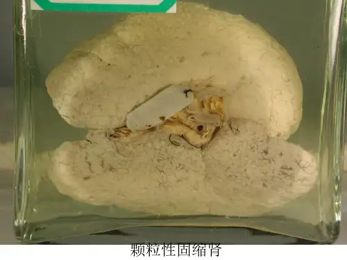 第十章 泌尿系统疾病