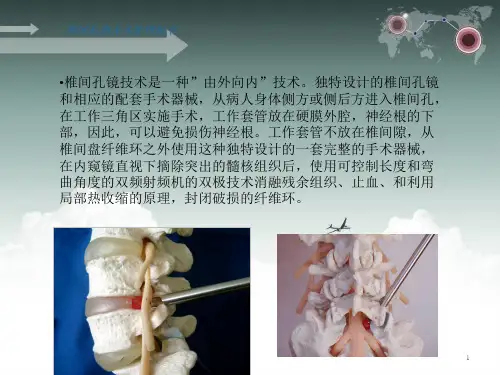 Joimax椎间孔镜手术护理配合课件