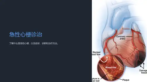 急性心梗诊治