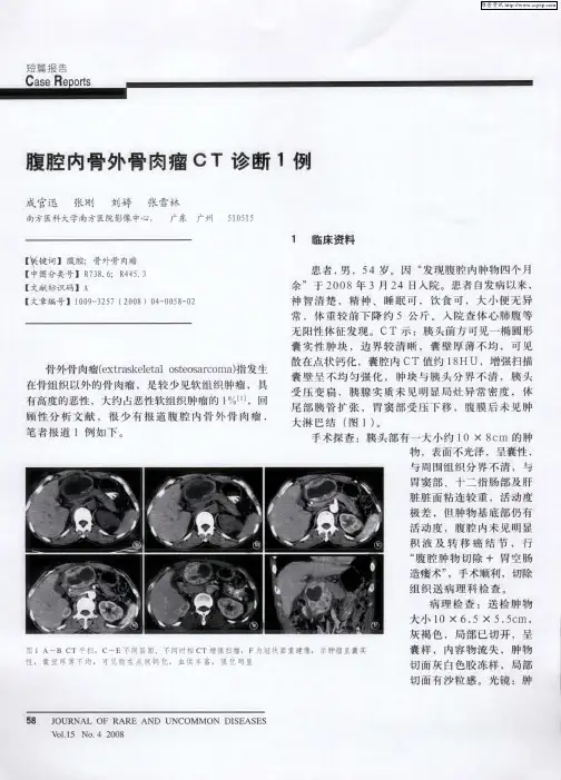 腹腔内骨外骨肉瘤CT诊断1例