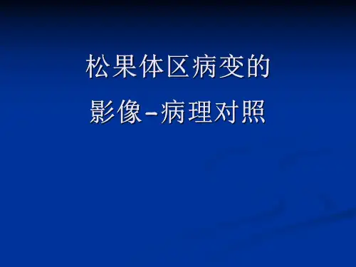 医学影像-松果体区病变的影像-病理对照