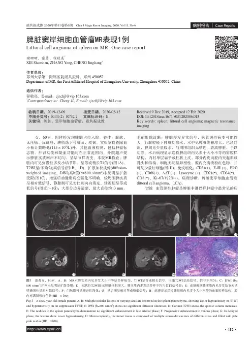 脾脏窦岸细胞血管瘤MR表现1例