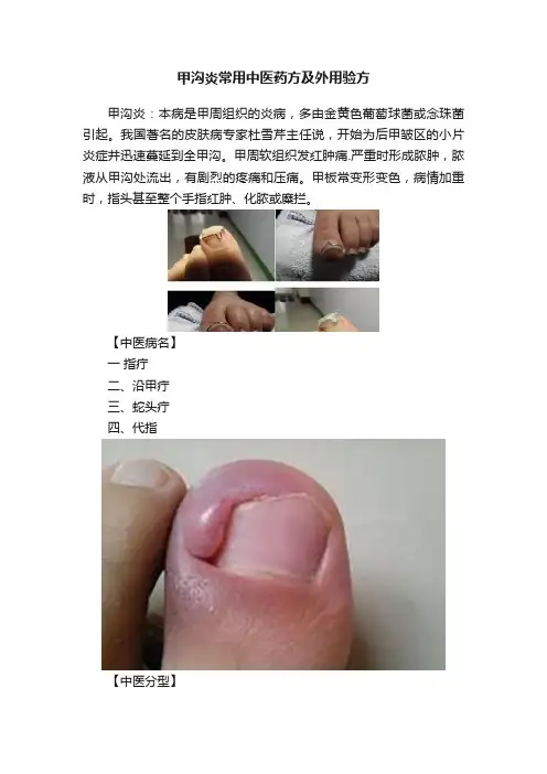 甲沟炎常用中医药方及外用验方