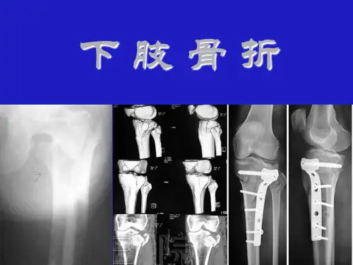 中医骨伤科学-下肢骨折(全套261页PPT课件)
