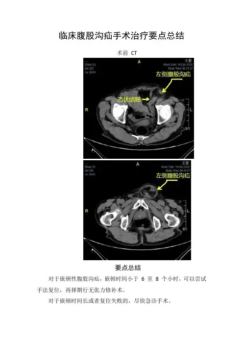 临床腹股沟疝手术治疗病例分享及要点总结