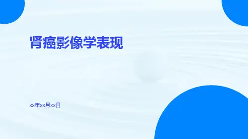 (医学课件)肾癌影像学表现