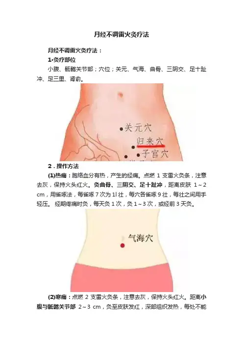 月经不调雷火灸疗法