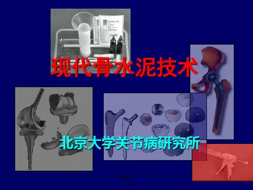 骨水泥技术(精制医学)