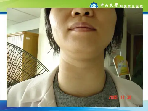 甲状腺功能亢进症最新PPT课件