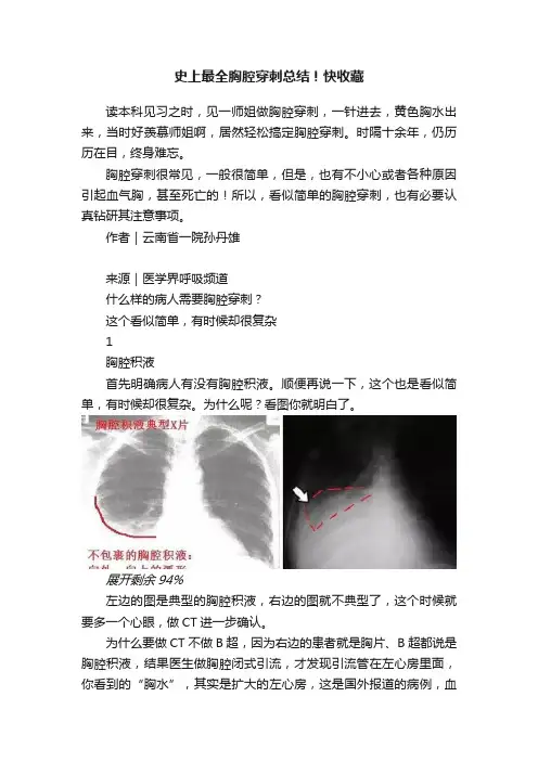 史上最全胸腔穿刺总结！快收藏