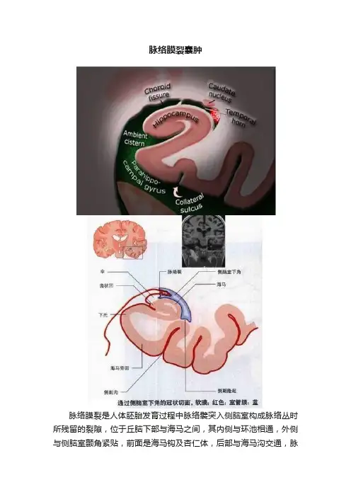 脉络膜裂囊肿