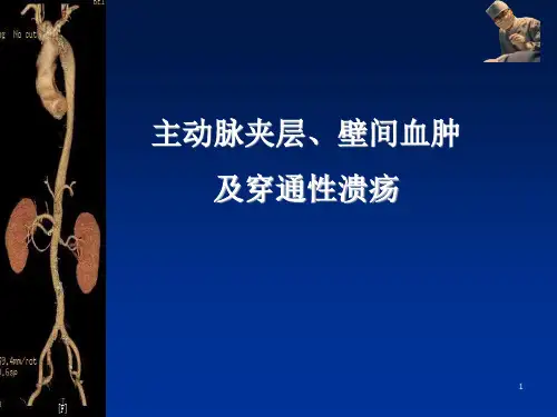主动脉夹层壁间血肿及穿通性溃疡的影像诊断与鉴别诊断ppt课件