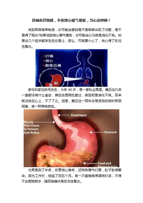 吞咽有异物感，半夜烧心嗳气胃胀，当心这种病！