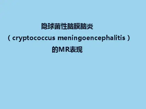 隐球菌性脑膜脑炎的影像表现