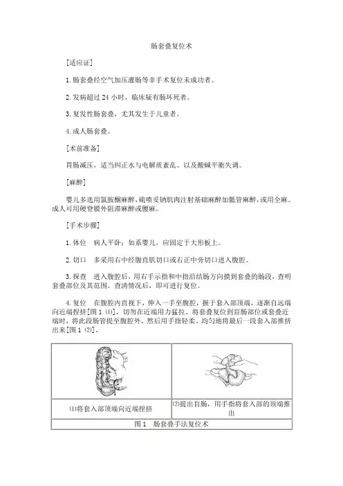 肠套叠复位术