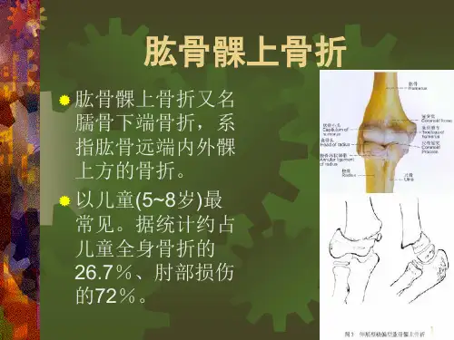 肱骨髁上骨折PPT课件