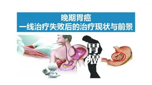 晚期胃癌治疗ppt课件