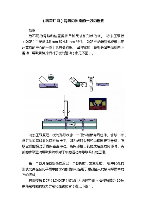 （科普扫盲）骨科内固定的一般内置物
