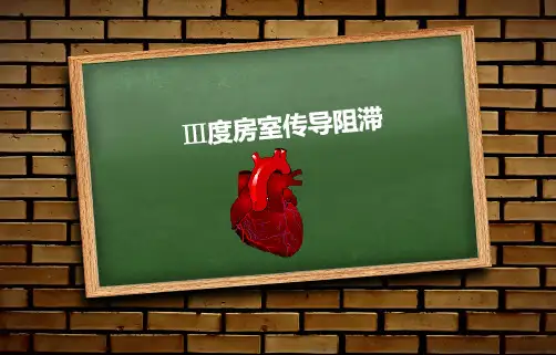 三度房室传导阻滞16948