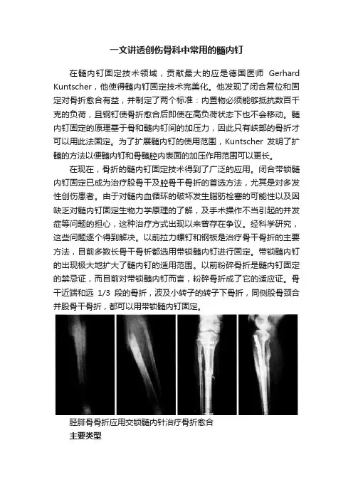 一文讲透创伤骨科中常用的髓内钉