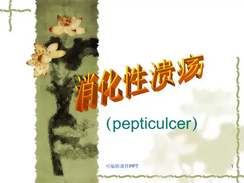 消化性溃疡精ppt课件