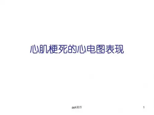 心肌梗死的心电图表现  ppt课件