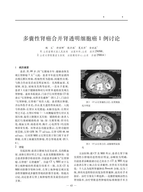 多囊性肾癌合并肾透明细胞癌1例讨论