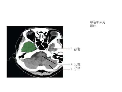 头部CTPPT课件