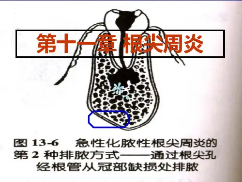 根尖周炎PPT课件