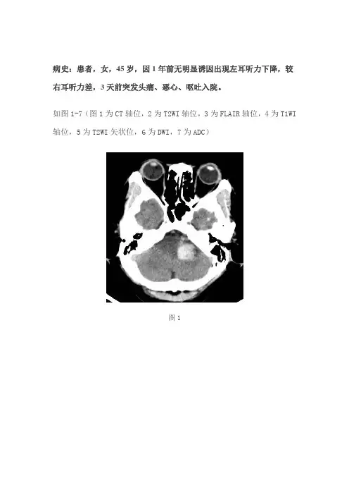 桥小脑角区短T1信号实性占位病变--听神经瘤合并出血