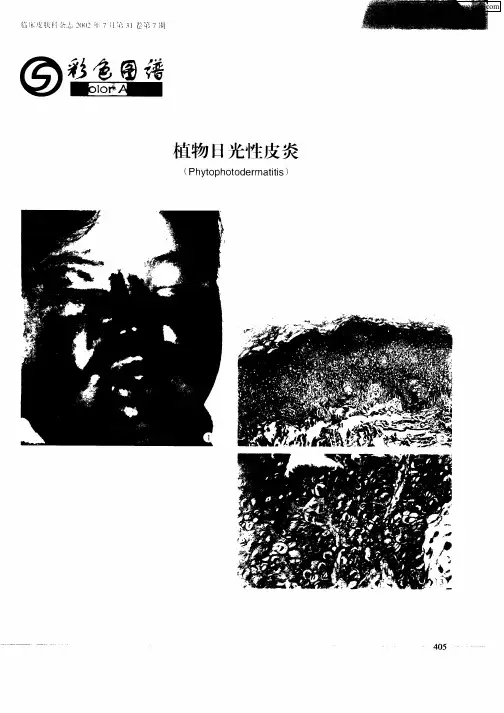 植物日光性皮炎