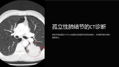 孤立性肺结节的CT诊断