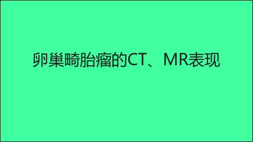 卵巢畸胎瘤影像诊断