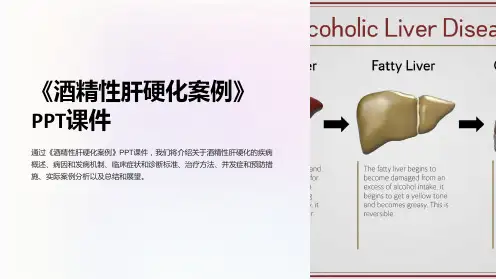 《酒精性肝硬化案例》课件