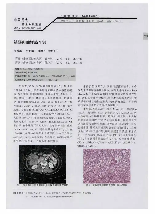 结肠肉瘤样癌1例