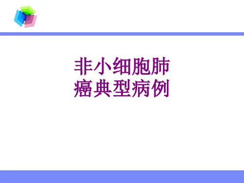 非小细胞肺癌典型病例优质PPT课件
