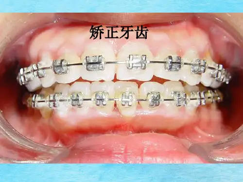 深圳矫正牙齿-口腔医院ppt课件