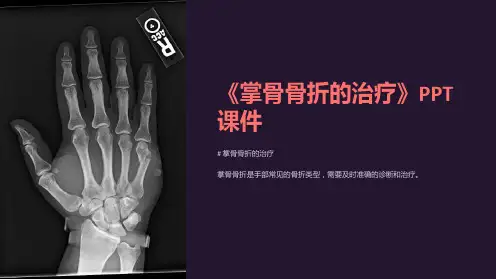 《掌骨骨折的治疗》课件