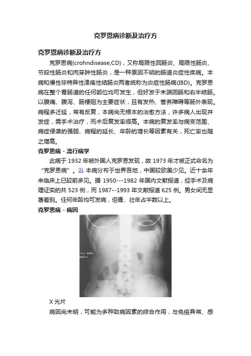 克罗恩病诊断及治疗方