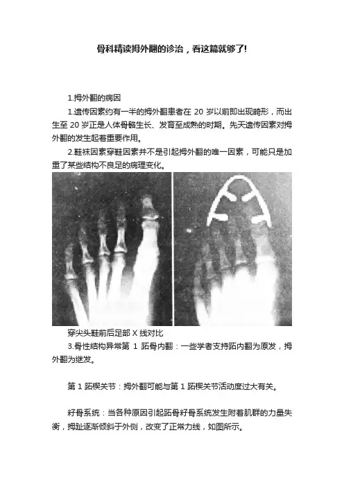 骨科精读拇外翻的诊治，看这篇就够了!