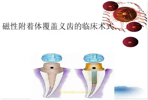 磁性附着体覆盖义齿临床术式
