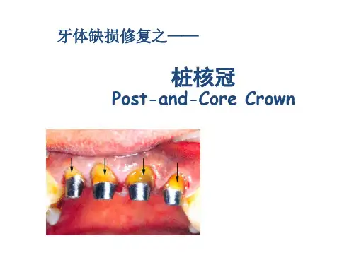 牙体缺损的修复—桩核冠
