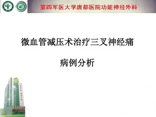 微血管减压术治疗三叉神经痛病例分析